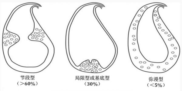 ascus和asch哪个严重(ascus和asch有何区别)-图3 ascus和asch哪个严重(ascus和asch有何区别)-图3