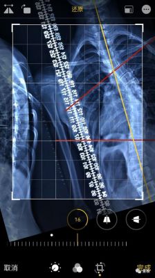 安卓专业测量软件哪个好(脊柱侧弯测量软件安卓)-图3 安卓专业测量软件哪个好(脊柱侧弯测量软件安卓)-图3