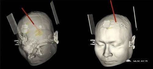 脑穿戴设备（脑穿刺视频）-图2